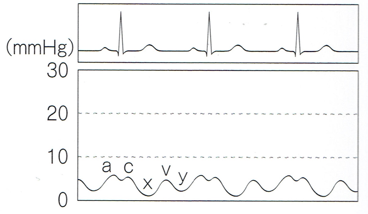 右心カテーテル検査 ― スワンガンツカテーテルで得られる一次情報まとめ【中編】 | CEじゃーなる