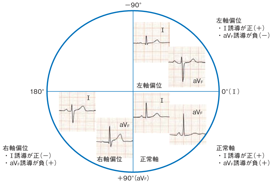 心電図 左軸偏位 時計回転