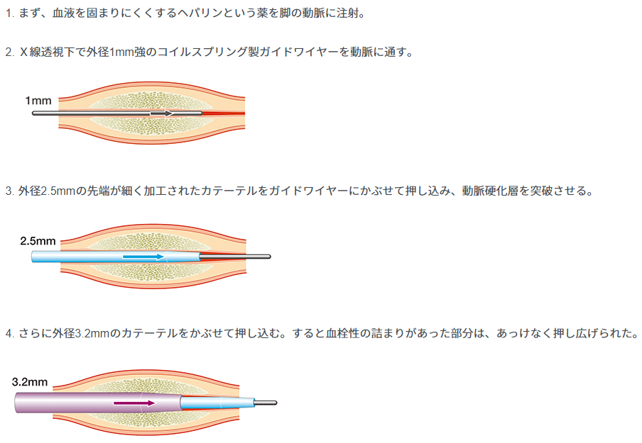 カテーテル治療の歴史と普及 ― DESが登場するまで ― | CEじゃーなる
